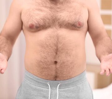 رجل يعاني من التثدي   قبل العملية   د  حسن النعيم الرياض