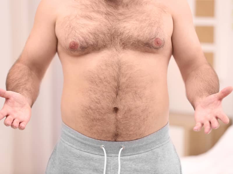 رجل يعاني من التثدي   قبل العملية   د  حسن النعيم الرياض