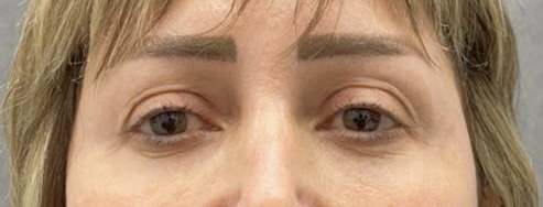 تكلفة وسعر شد الجفون السفلية وإزالة الدهون المترهلة وإعادة حقنها في الخفسات تحت العين Lower blepharoplasty
