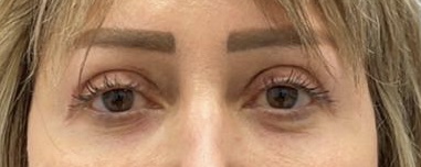 تكلفة وسعر شد الجفون العلوية وإزالة الدهون Upper blepharoplasty cost