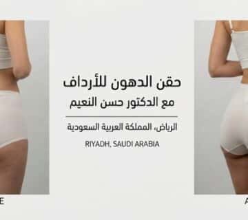 حقن الدهون للأرداف قبل وبعد مع د  حسن النعيم في الرياض