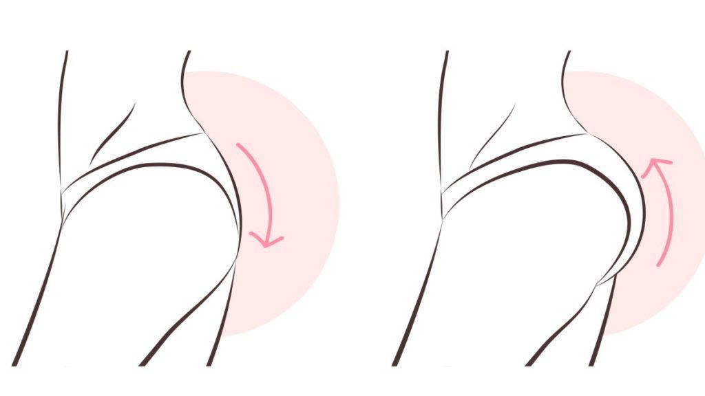 نحت الأرداف بحقن الدهون الذاتية - رفع وتكبير طبيعي مع د. حسن النعيم