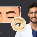 د  حسن النعيم الفرق بين قص الجفون ورفع الحاجب